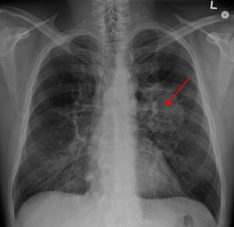 OMS anunță o creștere de 77% a cazurilor de cancer în viitor