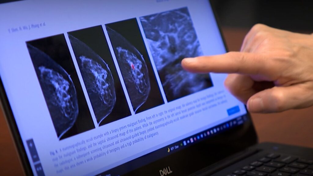 Specialiștii caută un nou tratament pentru cancerul de sân