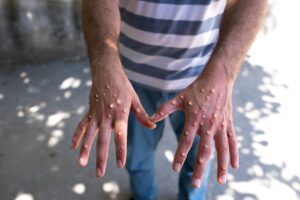 OMS lansează un plan de stopare a transmiterii virusului mpox
