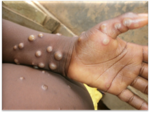 Pakistan a confirmat un caz de virus mpox