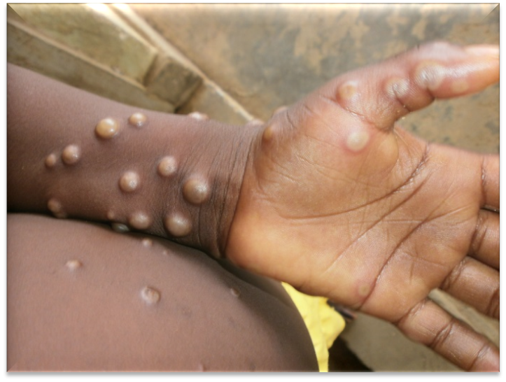 Pakistan a confirmat un caz de virus mpox
