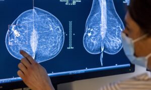 Inteligența artificială îmbunătățește predicția cancerului mamar