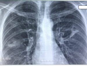 Tuberculoza ar putea fi eradicată