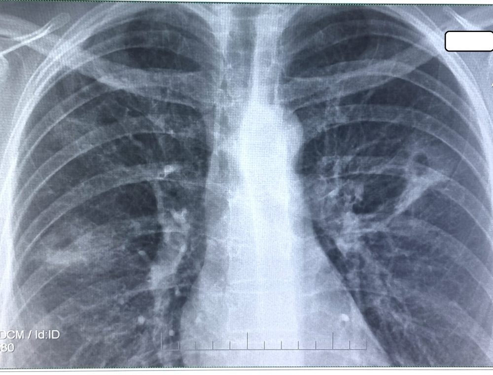 Tuberculoza ar putea fi eradicată